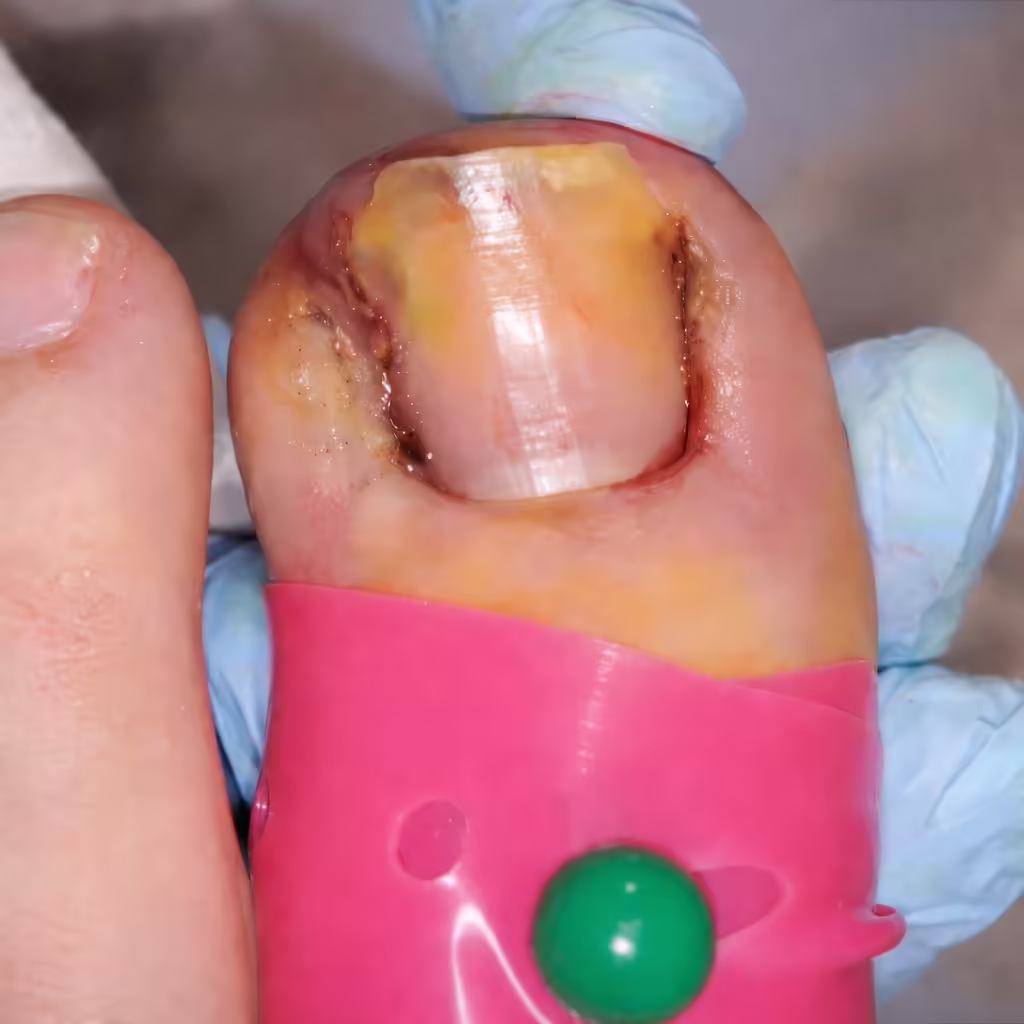 Ingrown 01