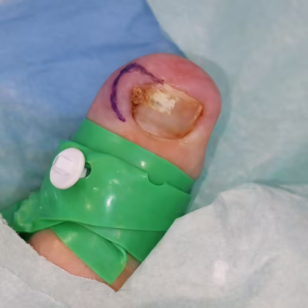 Ingrown2