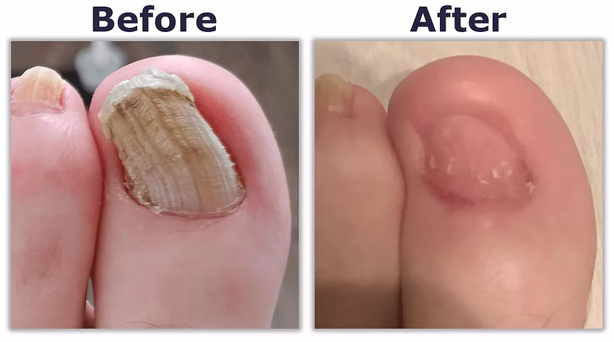 Permanent Nail Removal