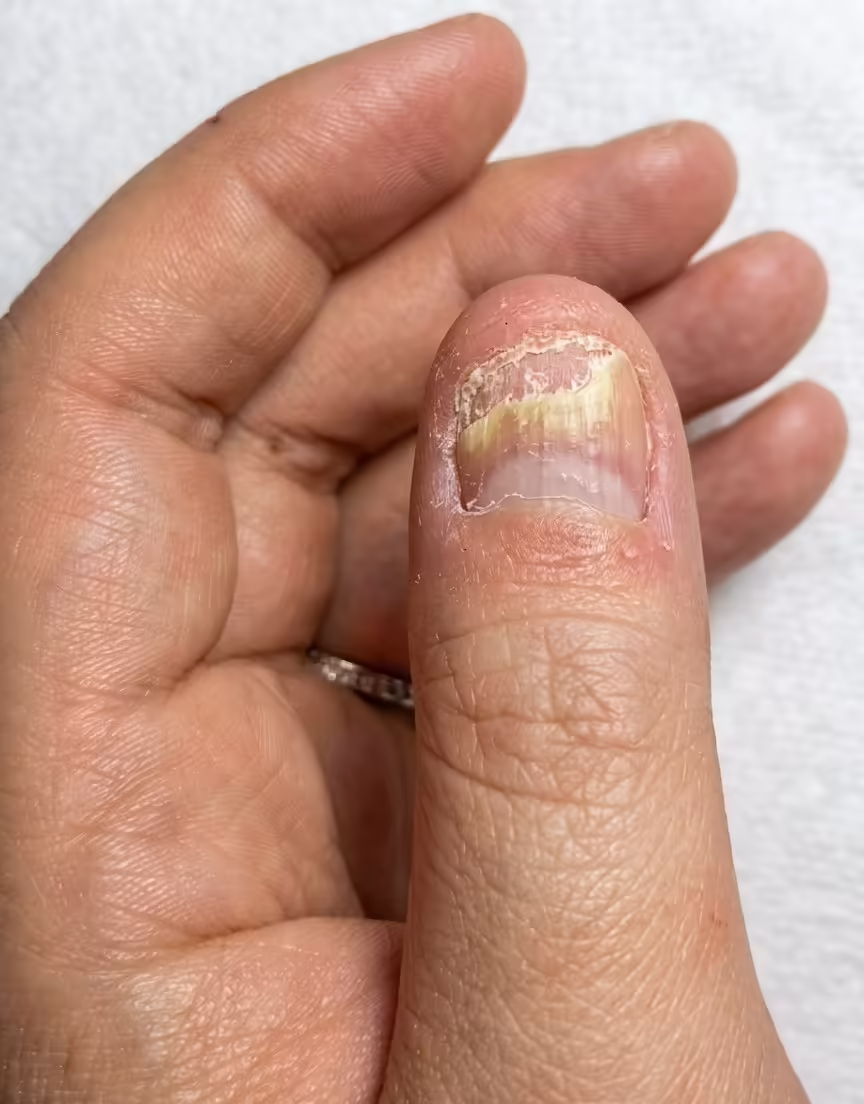 fingernails condition e1779806635785