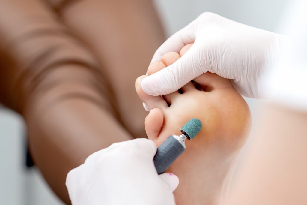 Are Acid Corn Plasters Safe, or Do They Just Burn Your Good Skin? 1 peeling feet pedicure procedure from callus on foo 2026 01 11 08 11 45 utc converted