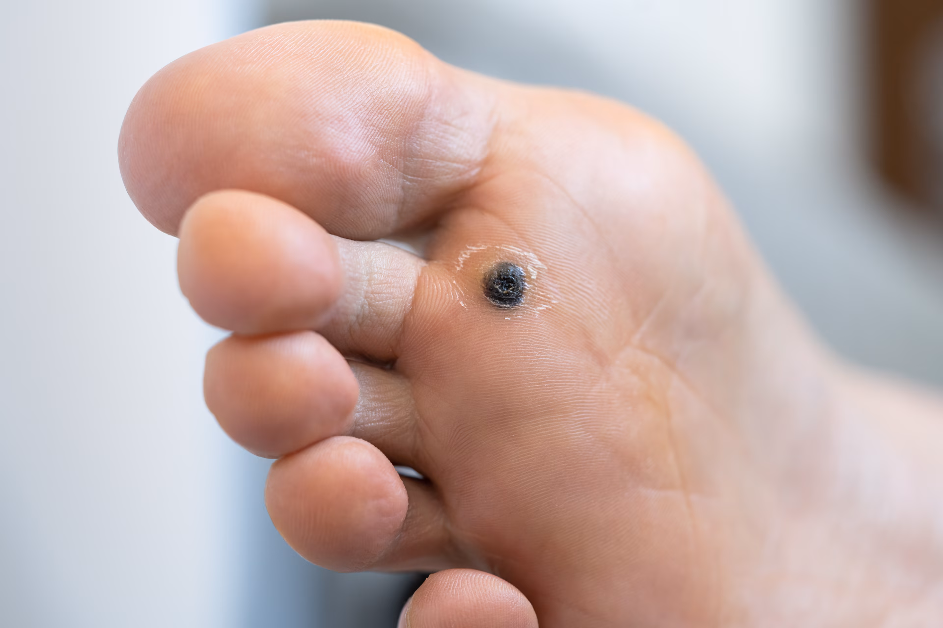 closeup of wart plantar after cauterizing it with 2026 01 08 07 01 31 utc converted