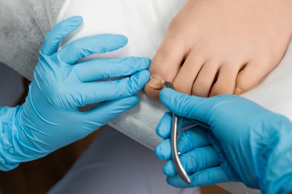 ingrown toenail procedure for female in beauty sal 2026 01 08 07 44 44 utc converted