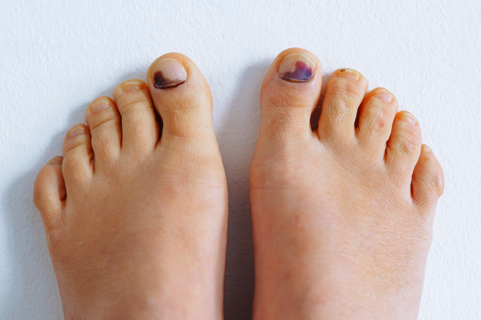 tired female feet barefoot with bruise on big toe 2026 01 08 06 29 57 utc converted