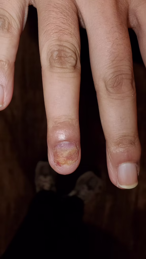 5 Things You Need To Know About Fungus-Infected Toenails 1 5 Things You Need To Know About Fungus-Infected Toenails