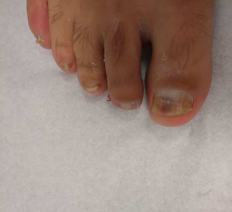 About a Toenail Surgery in London