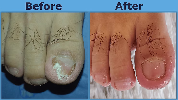 Risks You Can Avoid by Choosing Laser Fungal Nail Treatment in London