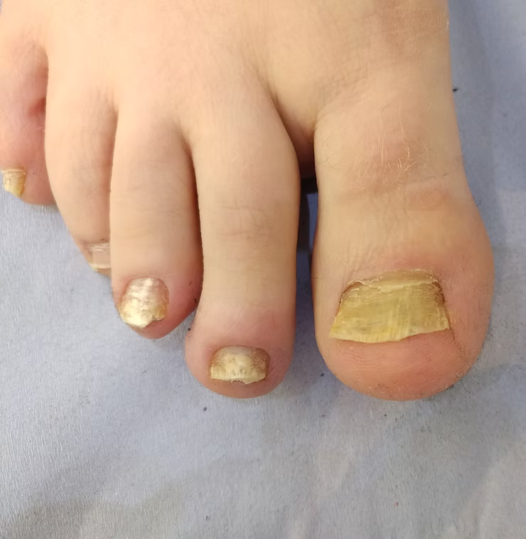 Three Types Of Nail Removal Surgery