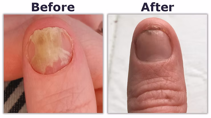 What To Expect From A Laser Fungal Nail
