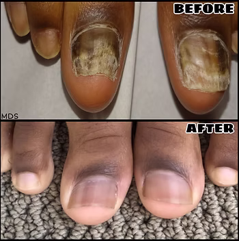 What Things to Consider for Toenail Fungus Treatment in London