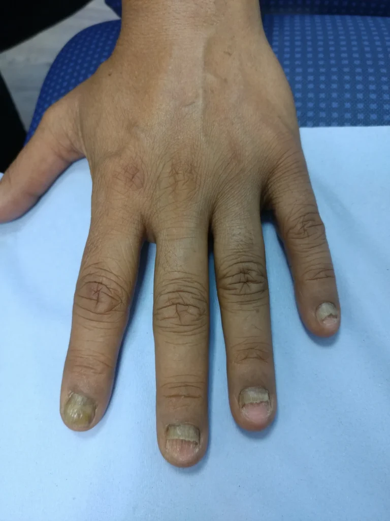 Toe Nail Removal in London: Who Should Consider This Surgery? 7 Toe Nail Removal in London: Who Should Consider This Surgery?