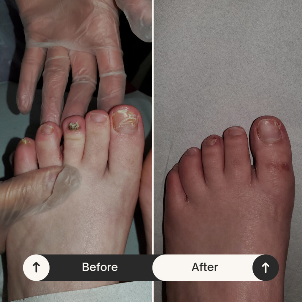 Why is My Fungal Nail Getting Worse in the Sun? 3 e3893f a0f4054913844039a8e9745f601b1cfbmv2