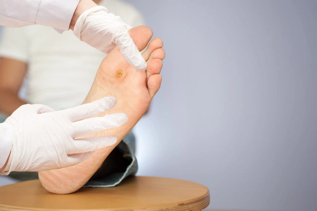 Stubborn Verruca? Get Expert Surgical Removal Now 8 e3893f e2d524132f834abba78eff8393e5ccedmv2 1