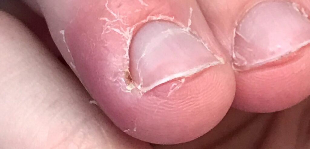 Can Pregnancy Cause Fungal Nail Infection? 9 e8a50b 0a2276cbf523406c8e6ef4c5effbca6fmv2