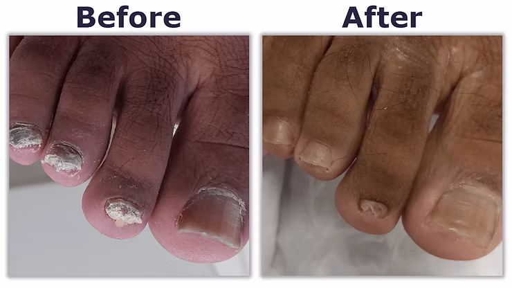 Why One Bad Toenail Can Damage Your Healthy Ones 2 https://www.footcliniclondon.co.uk/
