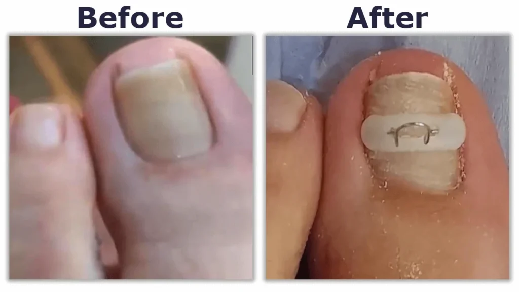 Nail surgery after sporting injury: A balance between healing and return to play 5 e8a50b 9ff8fa13c2a84b67a32e5d30cfe94e78mv2