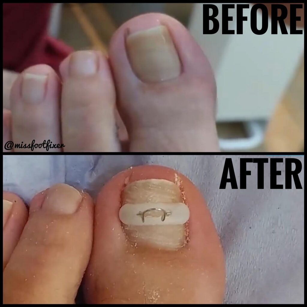 Advantages of Getting Laser Fungal Nail Treatment in London? 8 e3893f 5aff948428114080a01bbc23ea215054mv2