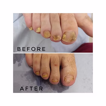 We Can Treat Fungal Nail Infection With A Laser